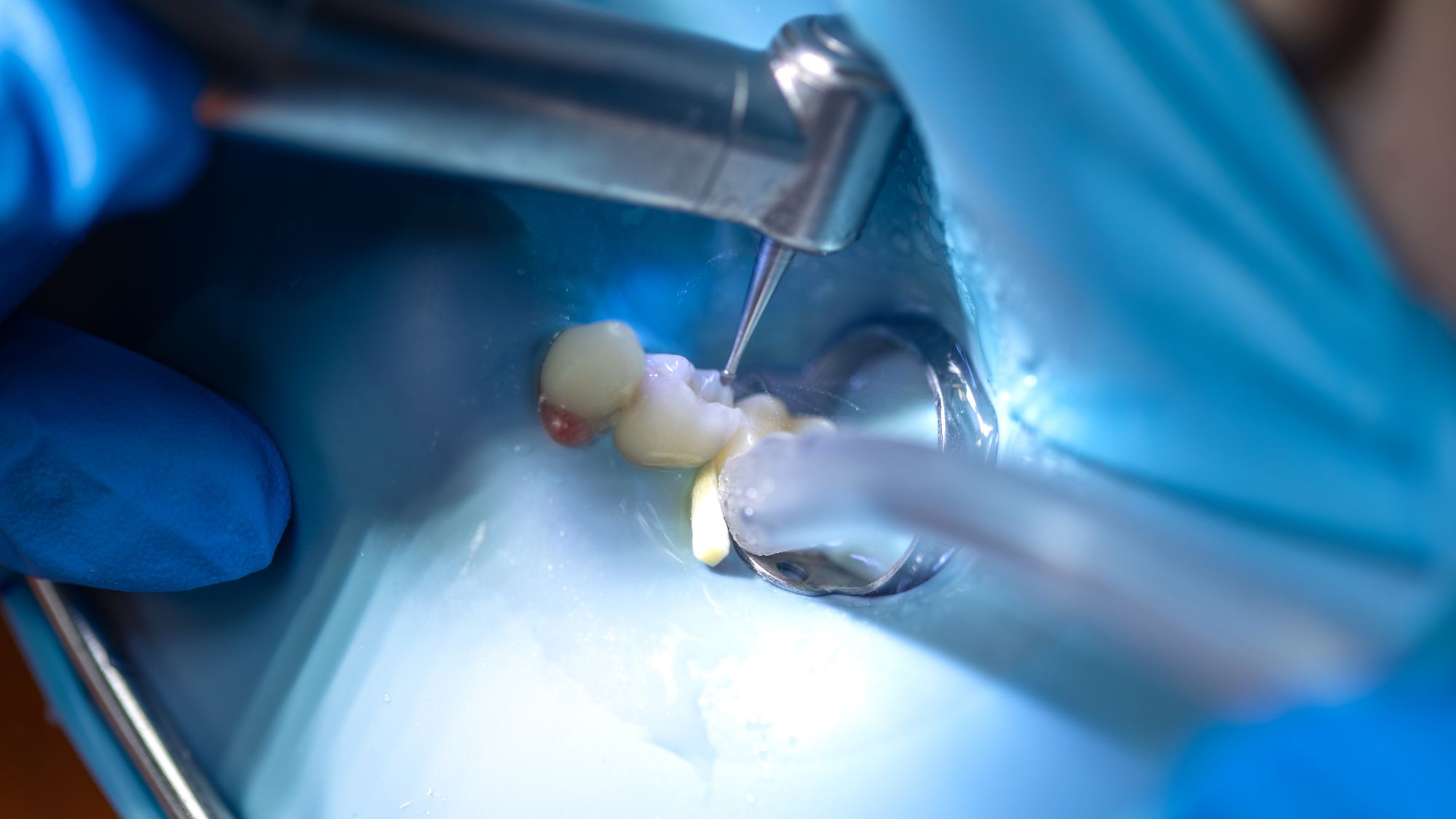 A dentist is undergoing a dental filling material process with a patient