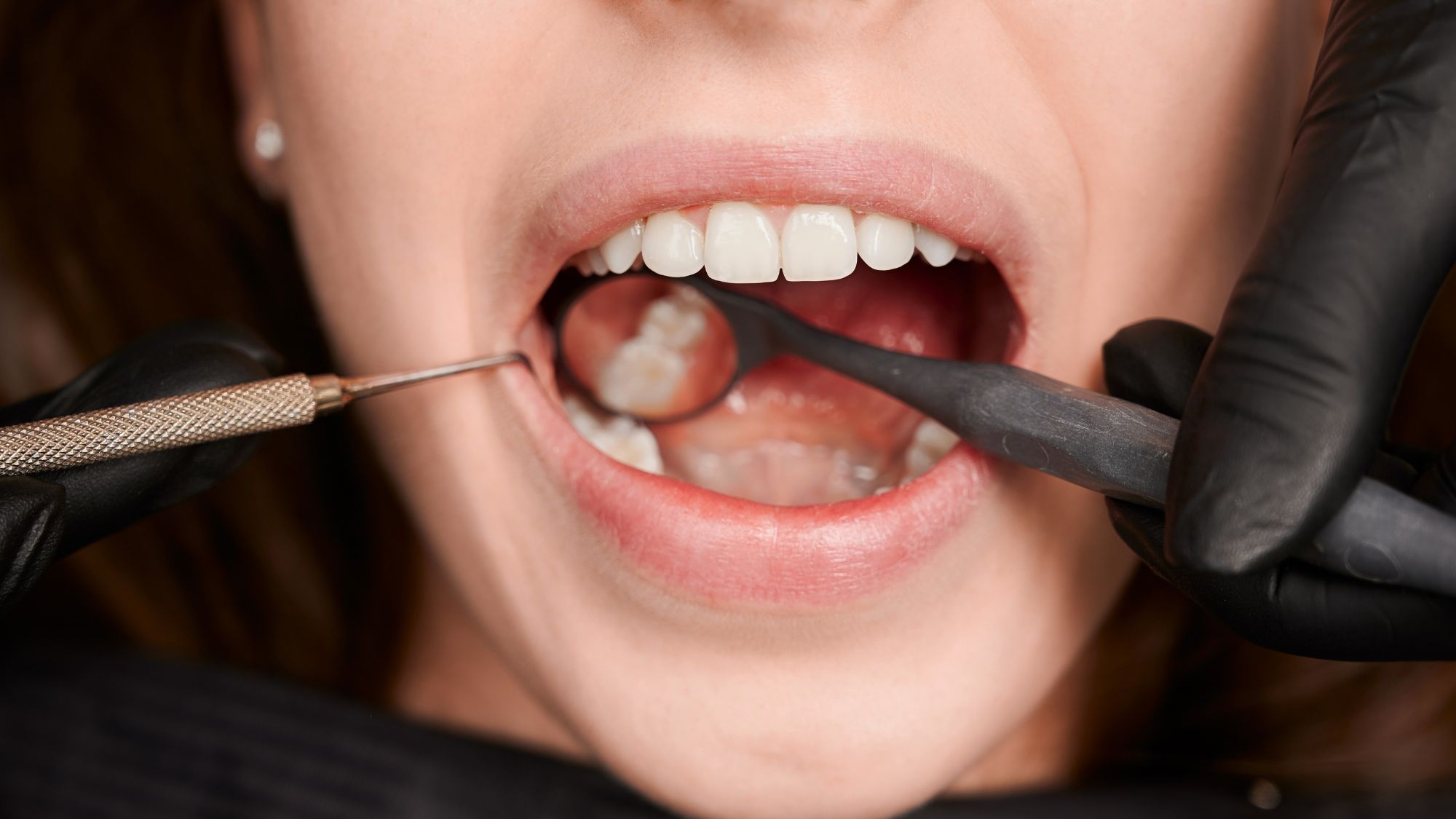 A young woman is undergoing a process of root canal and dental filling for cavities
