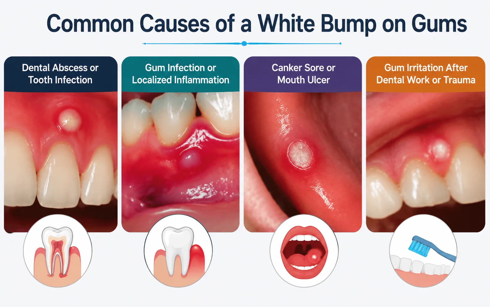 Infographic showing common causes of a white bump on gums including dental abscess, gum infection, canker sore, and gum irritation