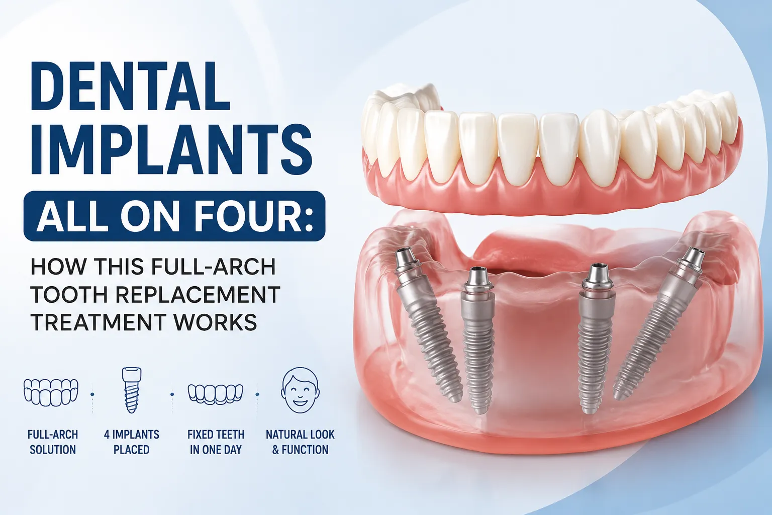 Dental implants All-on-4 full arch tooth replacement treatment showing four dental implants supporting a complete set of fixed teeth