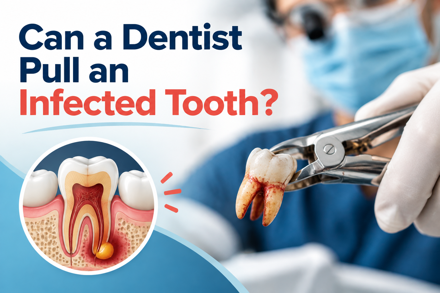Can a Dentist Pull an Infected Tooth